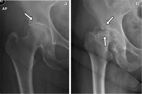 Subchondral Cyst Femoral Head