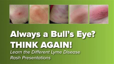 Think the Lyme Disease Rash is Always a Bullseye? THINK AGAIN! : Johns ...