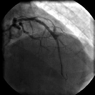 After first bare metal stent implantation following prolonged balloon ...