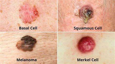 What Are the Different Types of Skin Cancer? | Christ Memorial