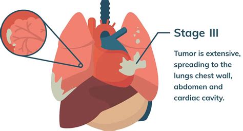 Malignant Mesothelioma Cancer | Stages, Prognosis, Treatment