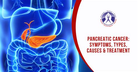 Pancreatic Cancer: Symptoms, Types, Causes & Treatment