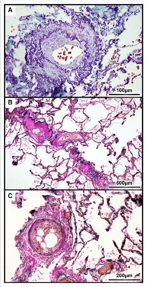 Histopathology of pulmonary vessels in pulmonary hypertension due to ...