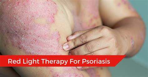 Red Light Therapy for Psoriasis: Does LED Light Therapy Work ...