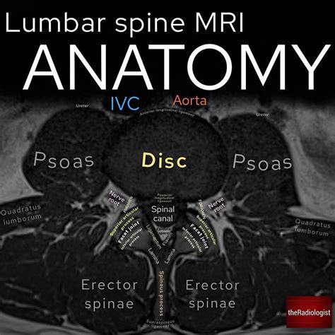 Axial Lumbar Mri Anatomy