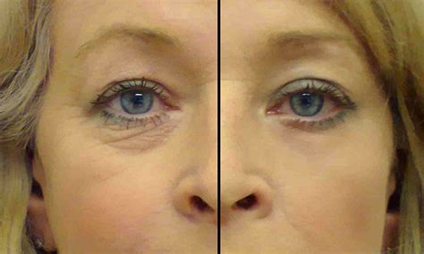 Eye Secrets: Anti-wrinkle patch can make you look 8 years younger in 15 ...