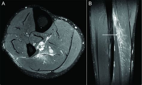 Connective tissue injury in calf muscle tears and return to play: MRI ...