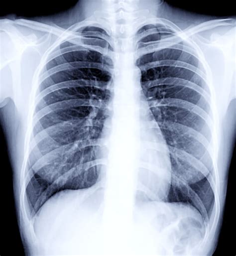 COPD Lung Normal Lungs: What COPD Looks Like, 53% OFF