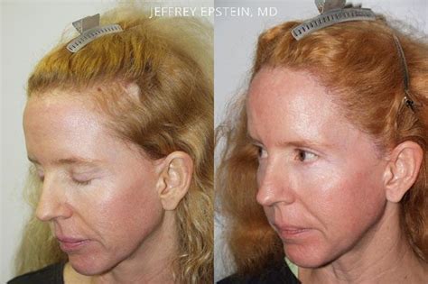 Facelift Scar Repair | Miami Repair Facelift Scarring | Hair Restoration