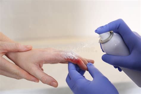 Applying Burn Spray Onto Injured Skin, Closeup Stock Photo - Image of ...