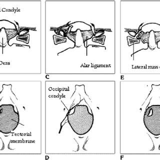 (PDF) Occipital condyle fracture in a victim of a motor vehicle collision