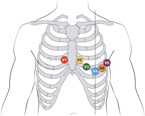 12-lead-ECG-lead-placement – FOAMmedic