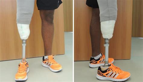 Researchers Create Perfect Fitting 3D Printed Transtibial Leg Socket ...