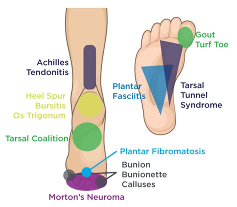 Pinpoint Your Foot & Ankle Pain | OrthoNebraska