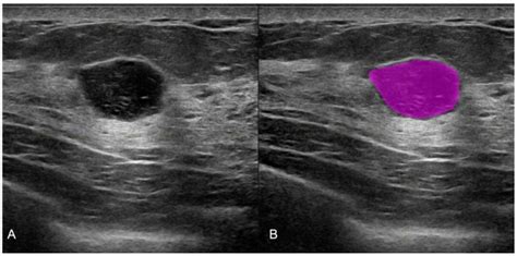 Breast Cancer Malignant Ultrasound Images