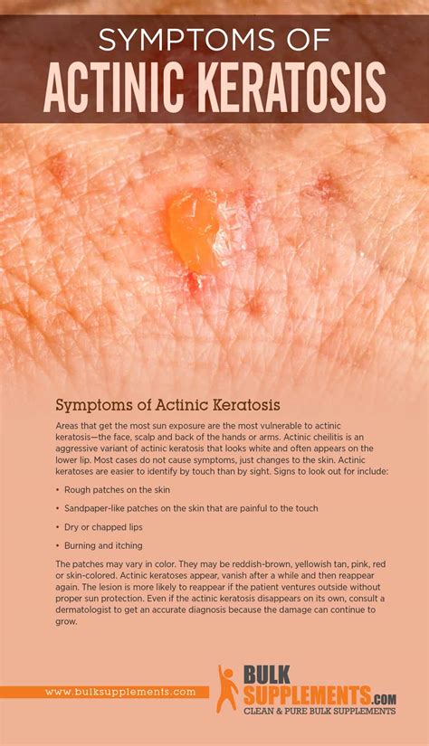 What is Actinic Keratosis: Symptoms, Causes, Treatment