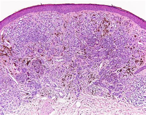 melanoma histology - pictures, photos