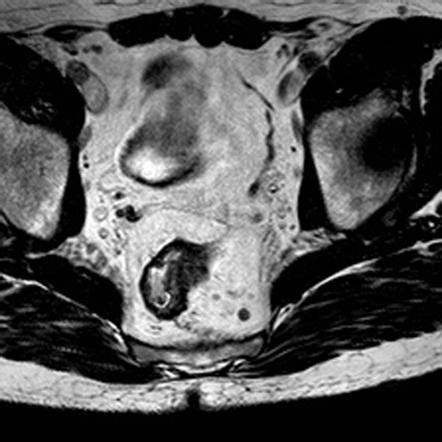 Pararectal Lymph Nodes