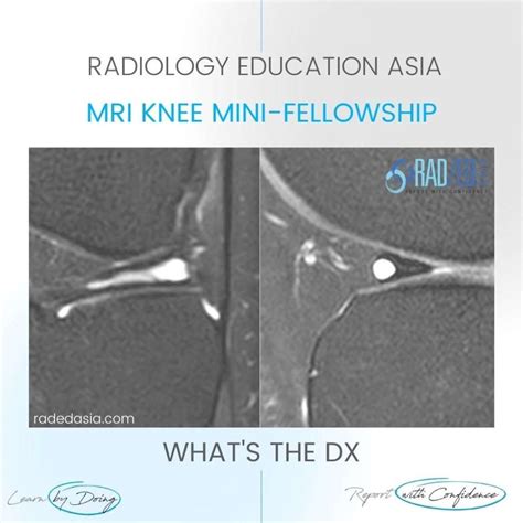 MENISCAL CYST RADIOLOGY INTRAMENISCAL TEAR MRI KNEE - Radedasia