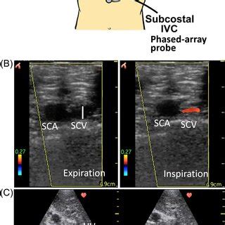 Ultrasound probe positions and ultrasound images of the subclavian vein ...