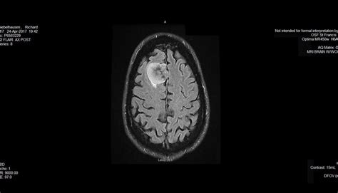 Brain Tumor Color Mri