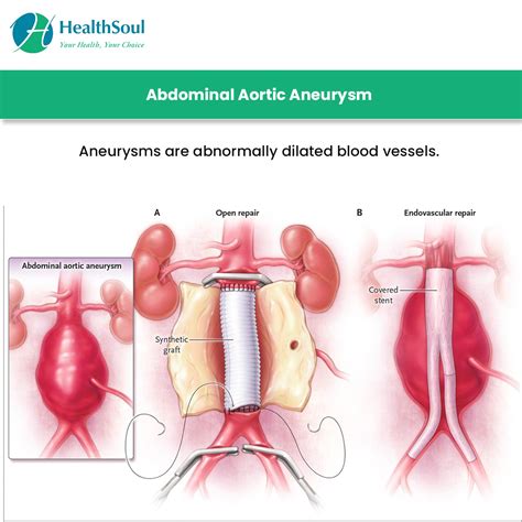 Abdominal Aortic Aneurysm Surgery: Indications and Risks – Healthsoul