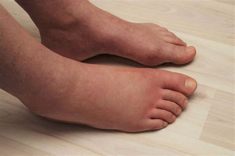 What Causes Swollen Feet and Ankles? – My FootDr