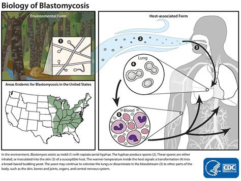 Blastomycosis in humans causes, symptoms, diagnosis and treatment