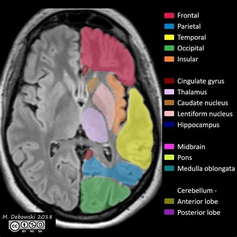 Ct Scan Brain Anatomy : Anatomy Of Head Ct Scan Normal The Brain On Ct ...