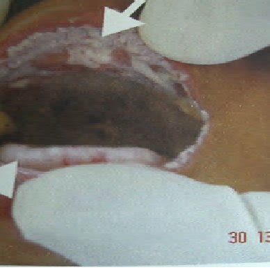 Linear gingival erythema. | Download Scientific Diagram