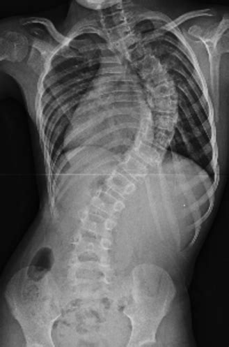 8 X-Rays That Show Why Early Detection is Key for Scoliosis | Children ...