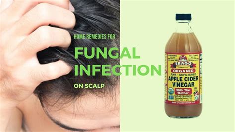 Home Remedies For Fungal Infection On Scalp - YouTube