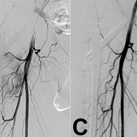 A 72-year-old man with T3 bone metastasis from prostate cancer treated ...