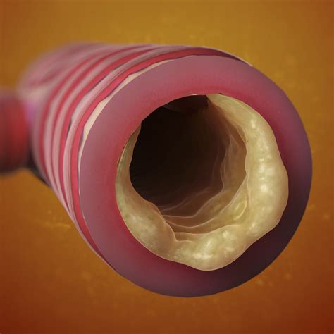 Images of How COPD Looks Inside of Lungs