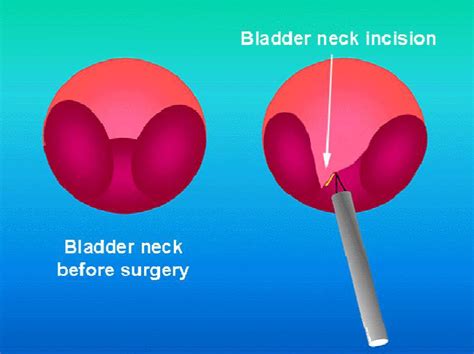 Holmium laser bladder neck incision | CUH