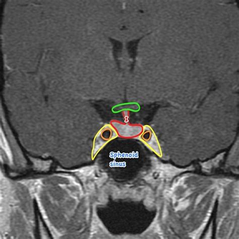 Pituitary MRI - normal study | Radiology Case | Radiopaedia.org ...