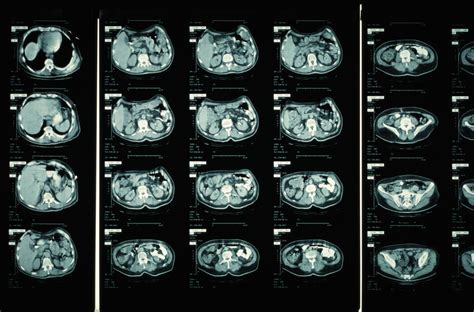 Brain Cat Scan Procedure