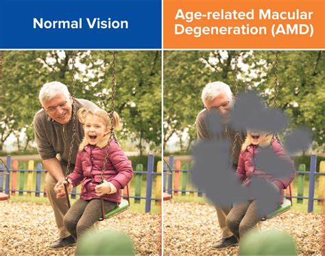 Syfovre: Dry Macular Degeneration Treatment in Venice FL