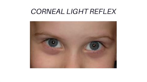 Corneal Light Reflex Abnormal Findings