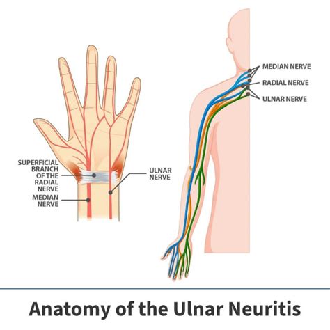 Ulnar Neuritis Information | Florida Orthopaedic Institute