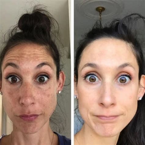 How I Got Rid Of My Melasma - Leah Behr