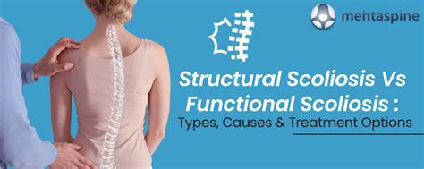 Structural Scoliosis Vs Functional Scoliosis : Overview