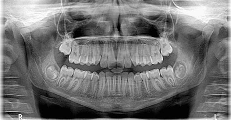 Different Types of X-Rays Explained: Rifkin Dental: Dentists