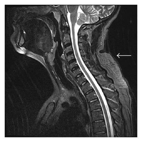 MRI of the neck demonstrates a subcutaneous mass (white arrows) in the ...