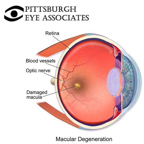 Macular Degeneration - Pittsburgh Eye Associates