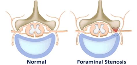 Foraminal Stenosis or Foraminal Narrowing - All You Need to Know