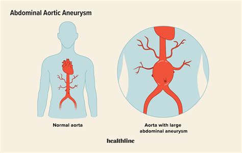 Abdominal Aortic Aneurysm: Causes, Treatment, and Prevention