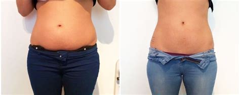 Cavitation v Fat Freezing (Cryolipolysis) | A New You