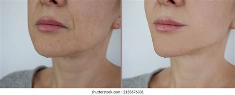 Woman Double Chin Before After Treatment Stock Photo (Edit Now) 1943967145