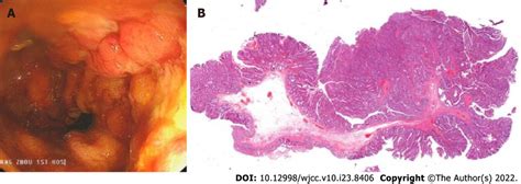 Removal of the metal stent and pathological findings. A: After the ...